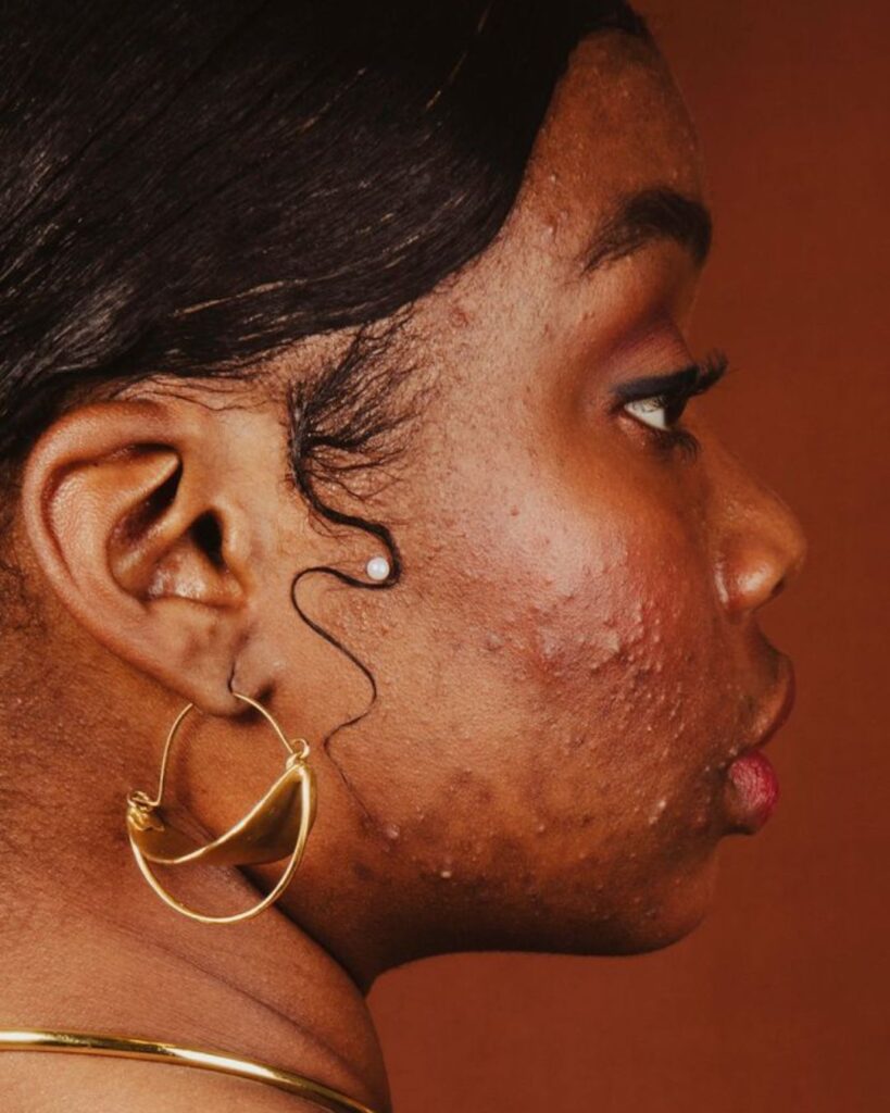 oily skin oily skin 2